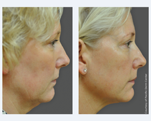 Load image into Gallery viewer, Ultherapy Sale