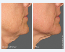 Load image into Gallery viewer, Ultherapy Sale