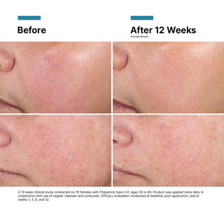 Before and after 12 weeks skin treatment comparison on a person's face.