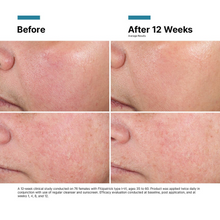 Load image into Gallery viewer, Before and after 12 weeks skin treatment comparison on a person&#39;s face.

