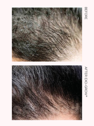 Intro Offer: Hair Restoration Package